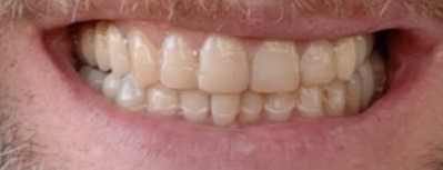 Rehabilitación Oral